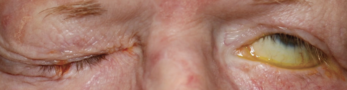 Poor Eyelid Closure (Lagophthalmos)
