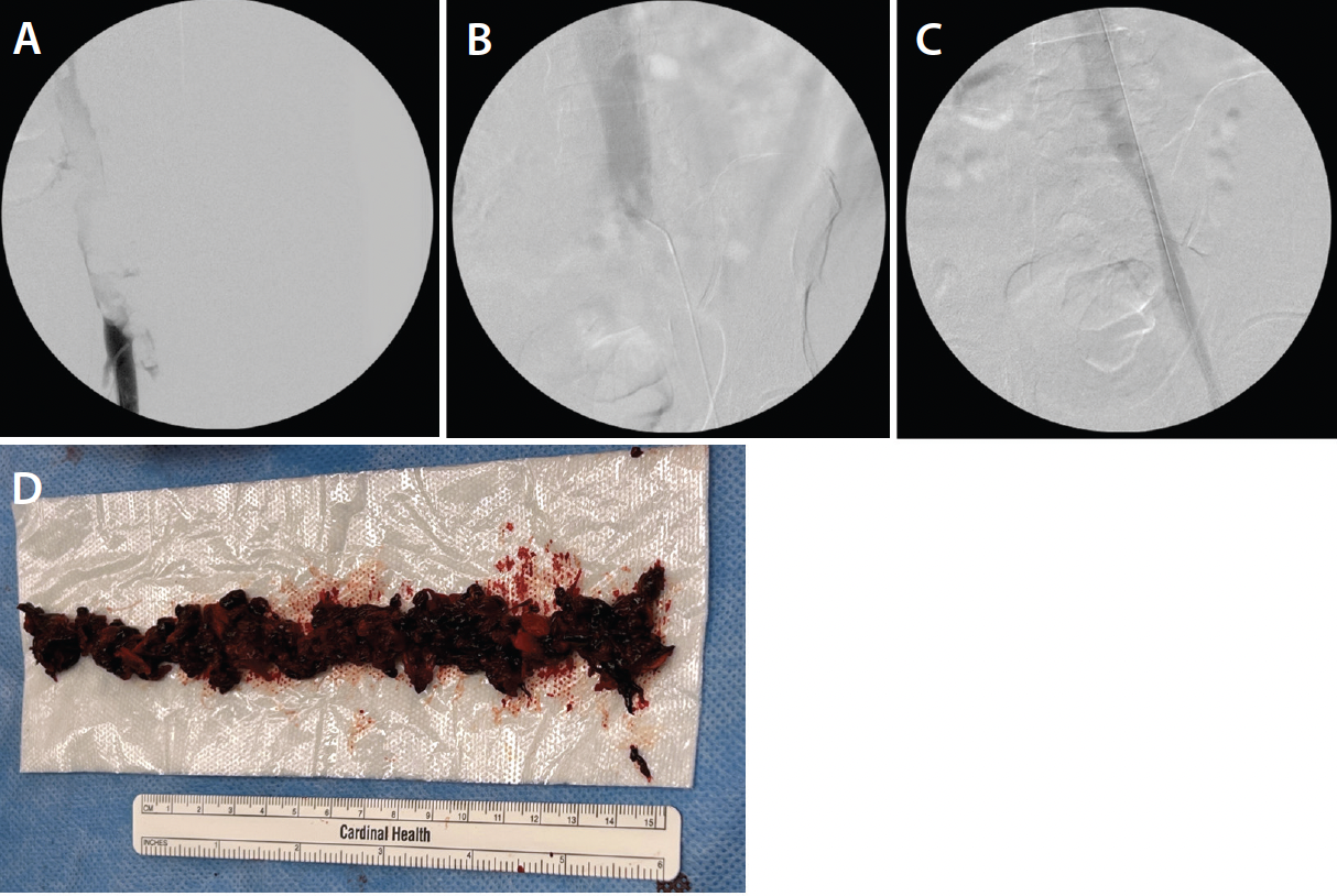 Mastopexy | Clinical Gate