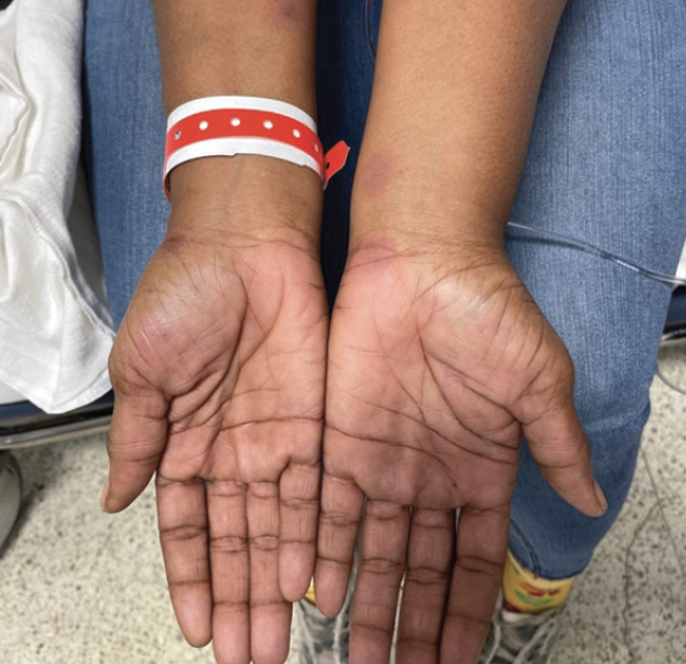 Erythema Multiforme Major Due to Fluconazole A Case Report Practical