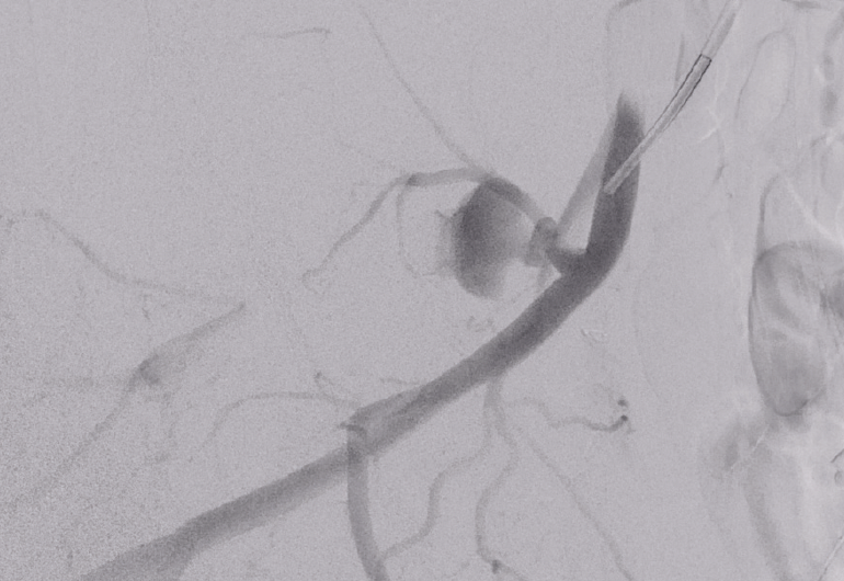 The Value of the Penumbra Coils in Trauma Management Endovascular Today