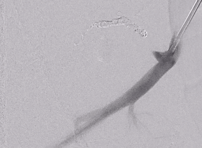 The Value of the Penumbra Coils in Trauma Management Endovascular Today