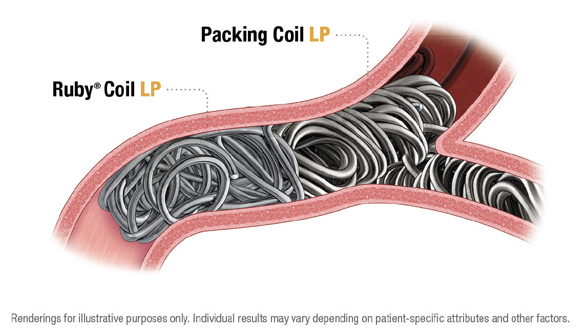 Frame, Anchor, Pack Simplifying Complex Cases With Penumbra’s Embolization Platform