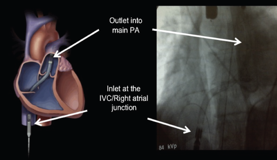 Managing Right Ventricular Failure in Pulmonary Embolism - Cardiac ...