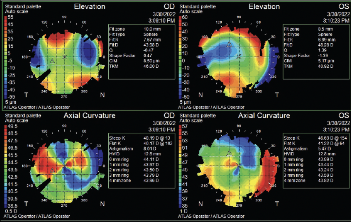 Corneal Transplant Support Group - Understanding the EYE CHART 20/20 or  6/6? Eye charts of different variations have become a standard in vision  screenings and eye exams. One of the most familiar