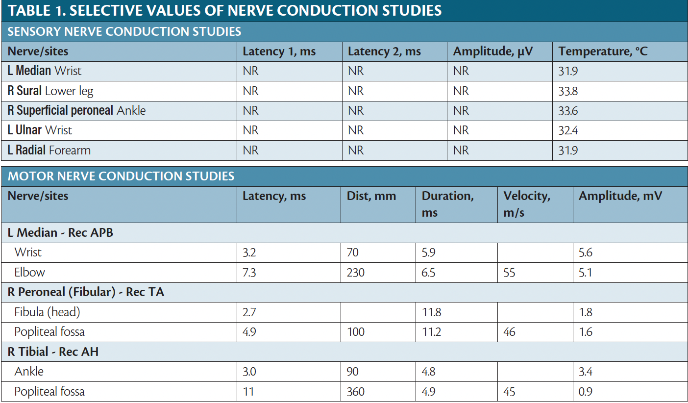 AcuteOnset Weakness, Deafness, and Confusion A Case of Multisystem