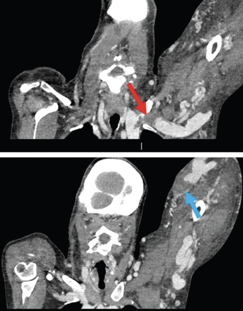 Demonstrating the Lightning™ System With ComputerAided Thrombectomy