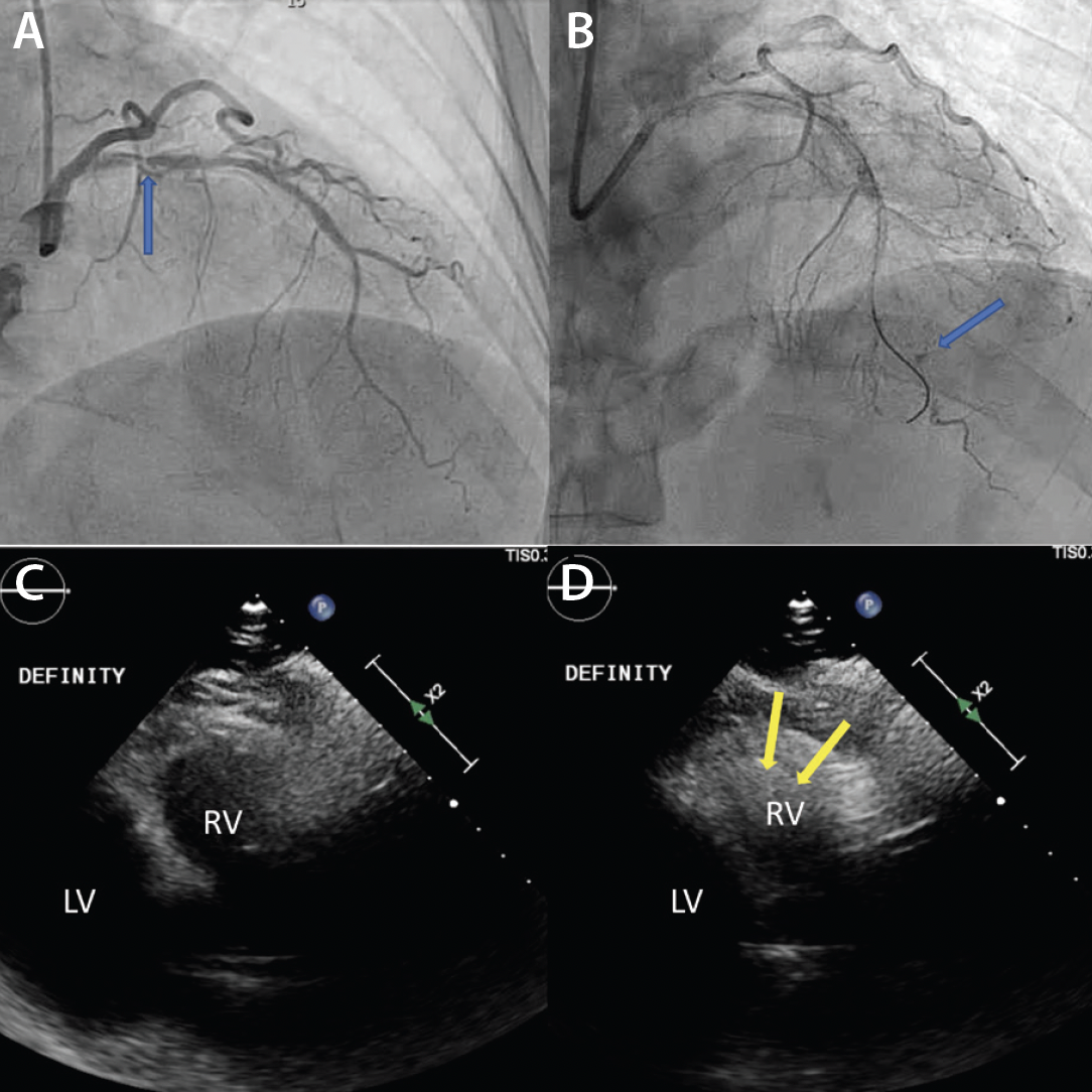 Contrast-Enhanced Echocardiography for Evaluating Coronary