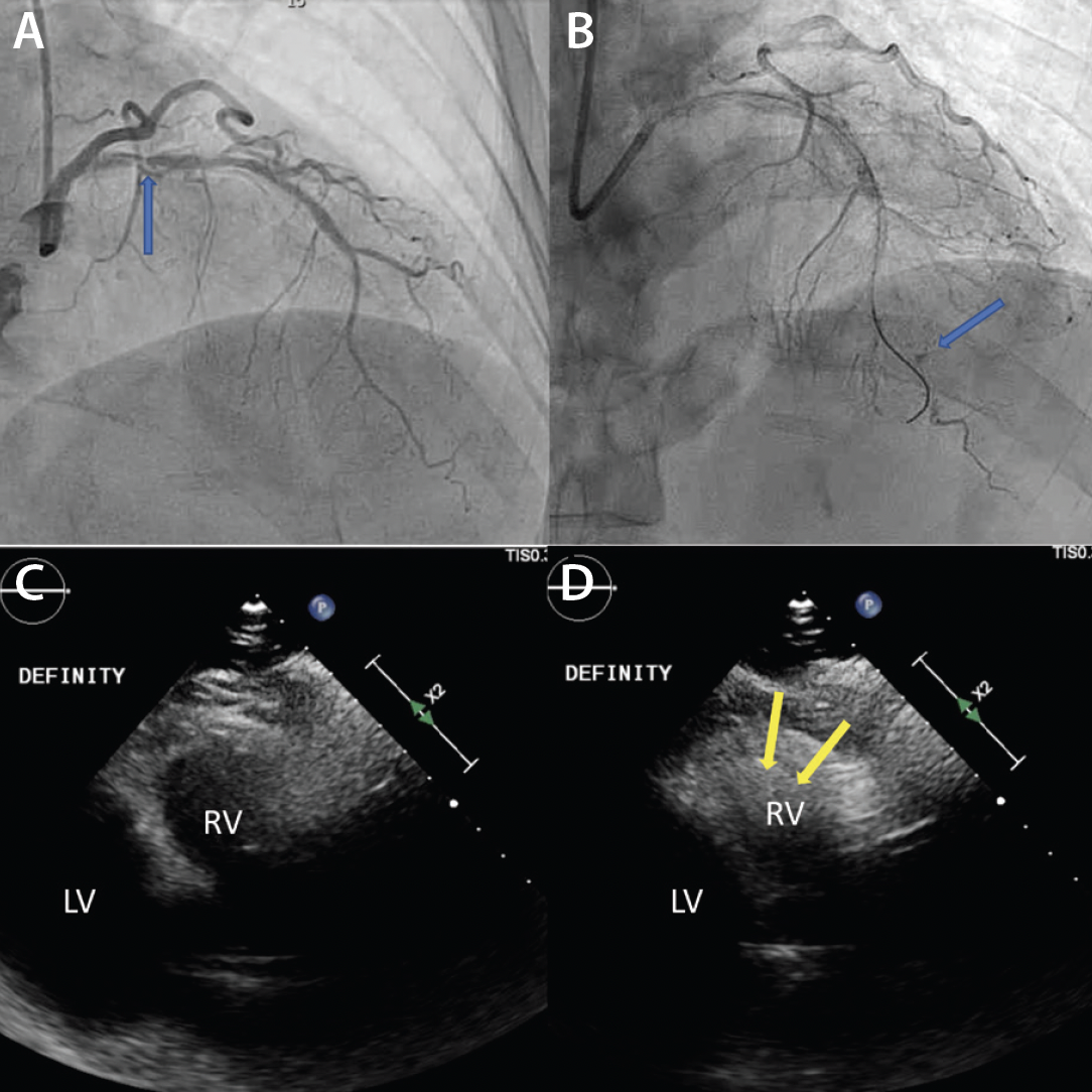 Transthoracic Echocardiographic Images Obtained after Cardiac  Catheterization 