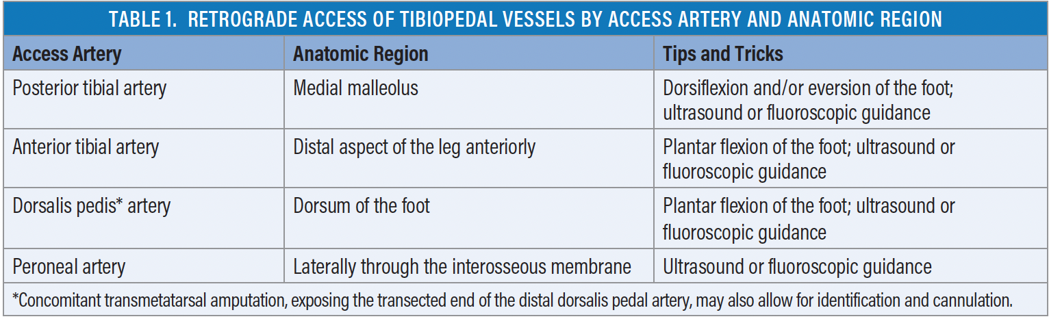 Retrograde Tibiopedal Access For Crossing Complex Lesions ...