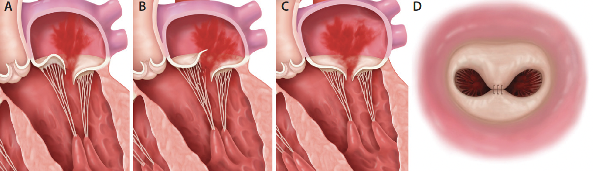 Background: A Surgical Foundation for the MitraClip™ Device - Cardiac ...