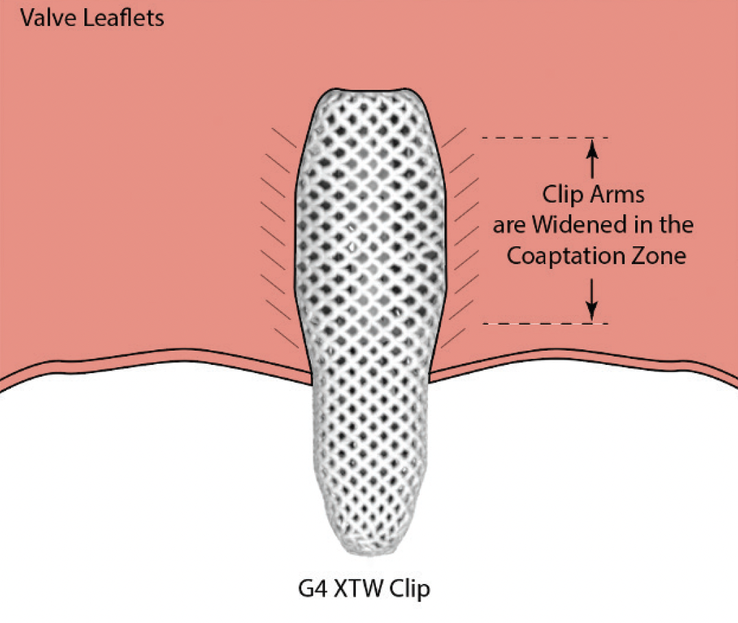 Design, Development, And Clinical Experience Of Four MitraClip™ Device ...