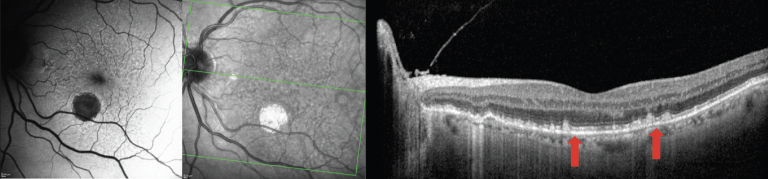 Tips For Recognizing And Understanding Oct Biomarkers - Modern Optometry