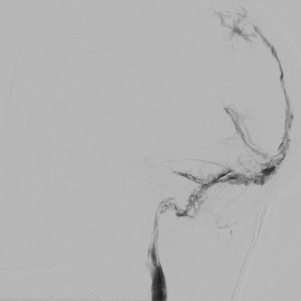 Management of Vein of Galen Thrombosis With Mechanical Thrombectomy ...