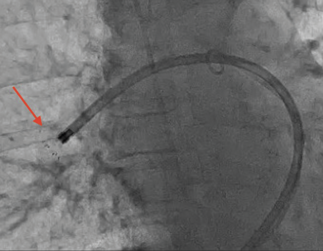 The Akura Thrombectomy Catheter System for the Treatment of VTE ...