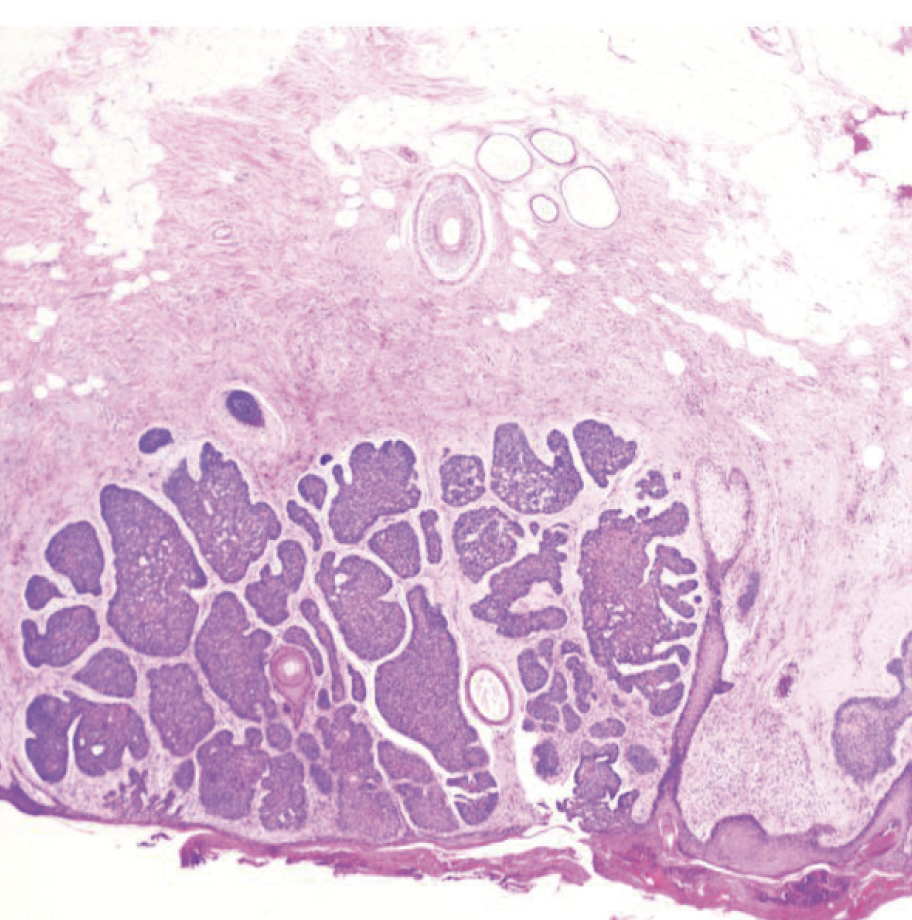 Signet Ring Cell Carcinoma of the Breast: An Aggressive Tumor