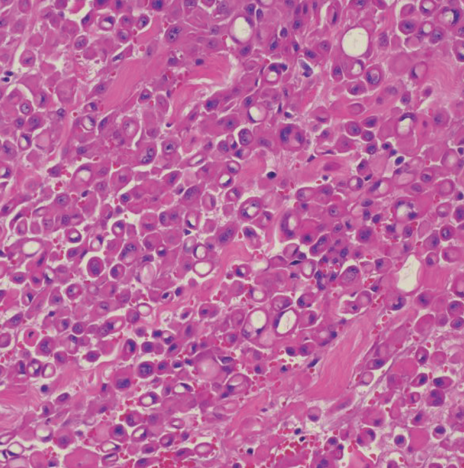 Signet-Ring Cell Carcinoma of the Gallbladder: a Case Report