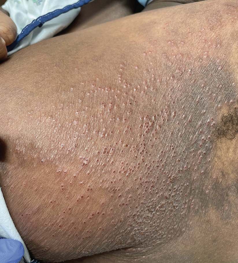 Eczema Herpeticum in A 20yearold Woman with a History of Atopic