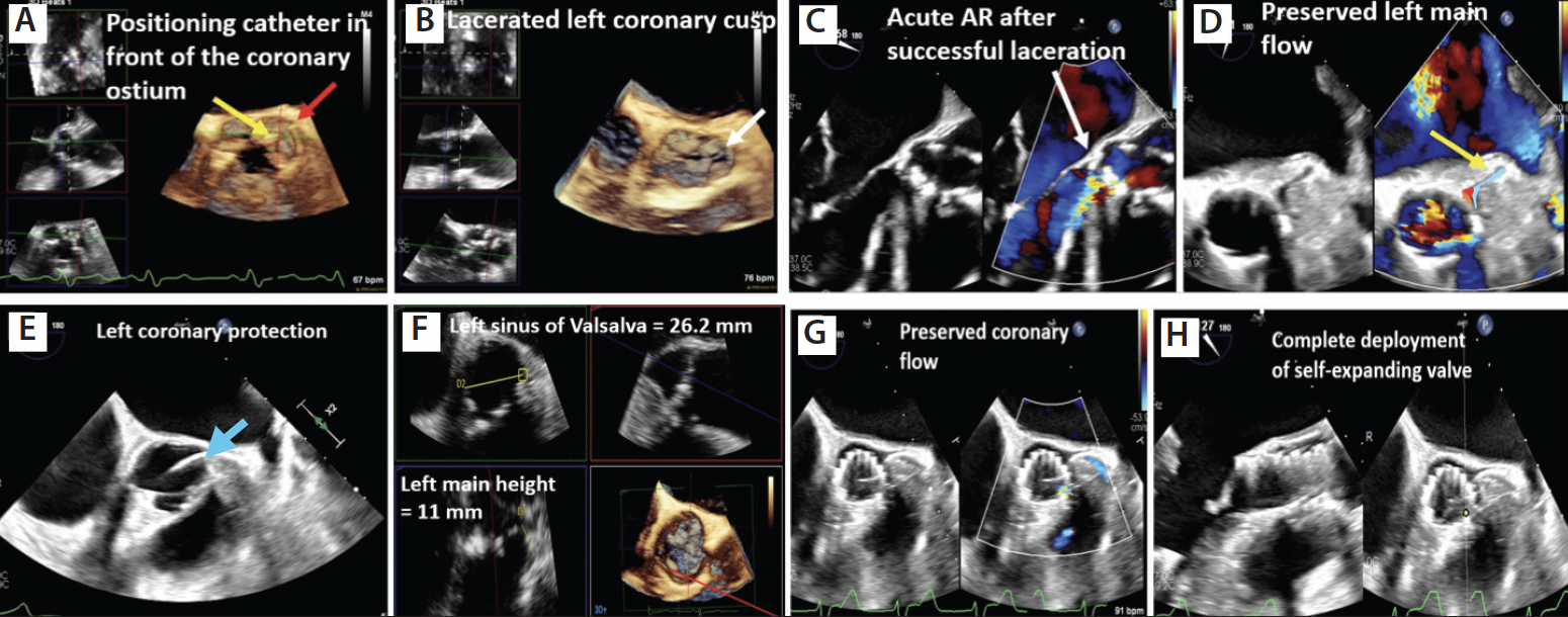 The Continued Role of Transesophageal Echocardiography in TAVR: When a ...