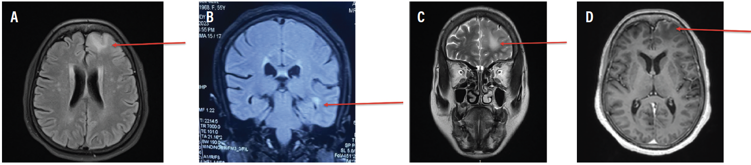 LGI1 Antibody Encephalitis Presenting as Focal Cortical Encephalitis ...