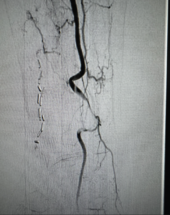 Case Report: Successful Removal of Brachial and Ulnar Artery Thrombus ...