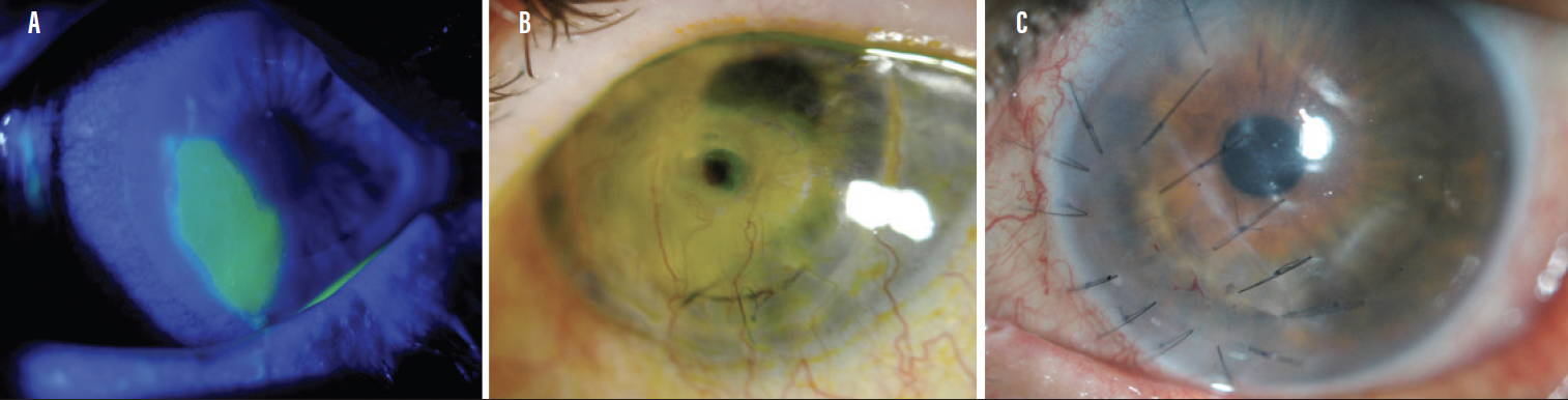 The Ocular Manifestations of GVHD - Modern Optometry