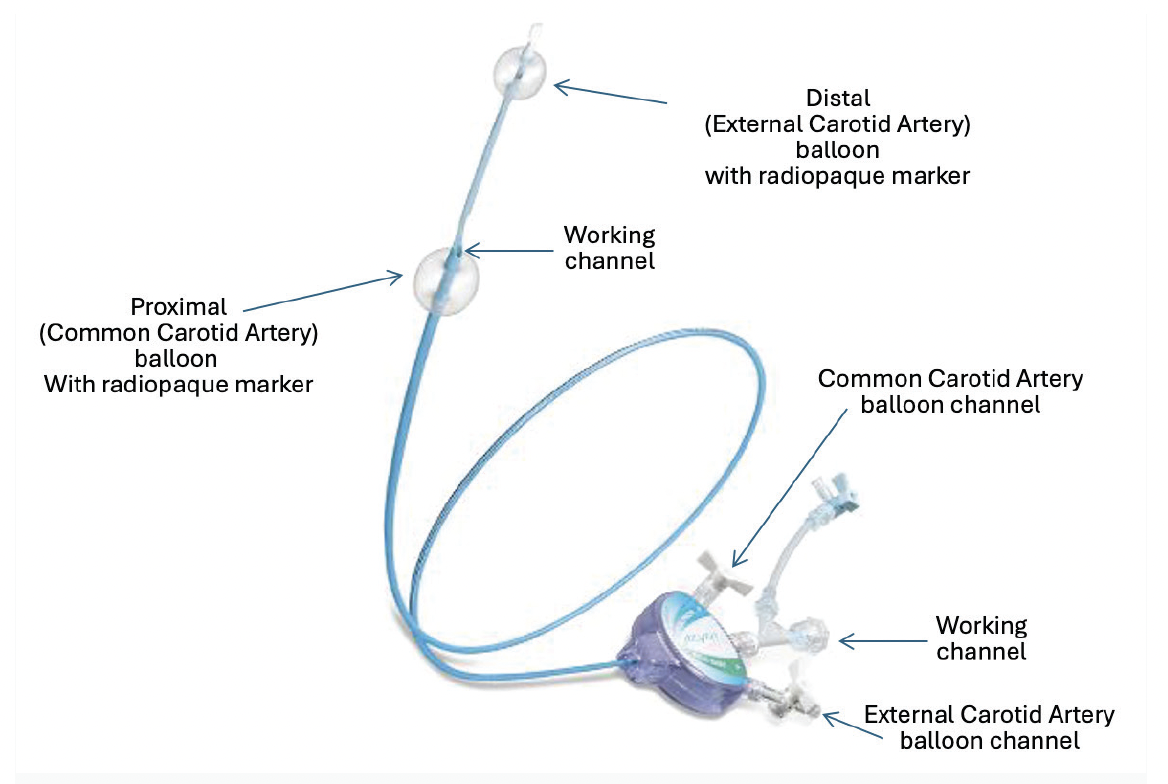 Proximal Embolic Protection With the Mo.Ma Ultra™ Device: A “Must Know ...