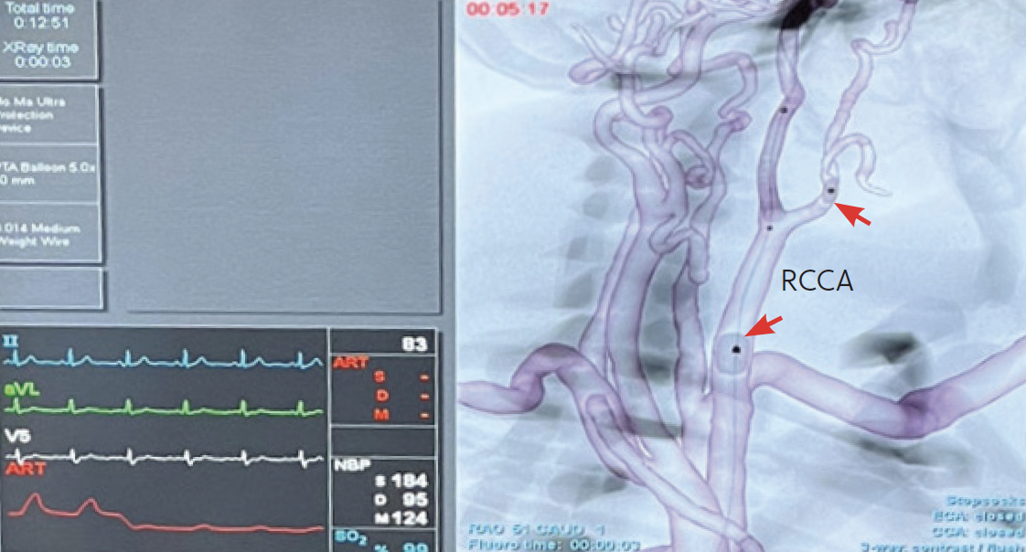 Proximal Embolic Protection With the Mo.Ma Ultra™ Device: A “Must Know ...