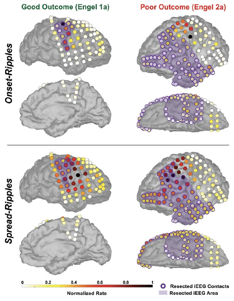 Epilepsy Essentials Novel Interictal Biomarkers For Delineating The Epileptogenic Zone In