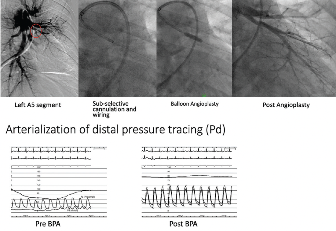 Step-by-Step Approach to Balloon Pulmonary Angioplasty for CTEPH ...