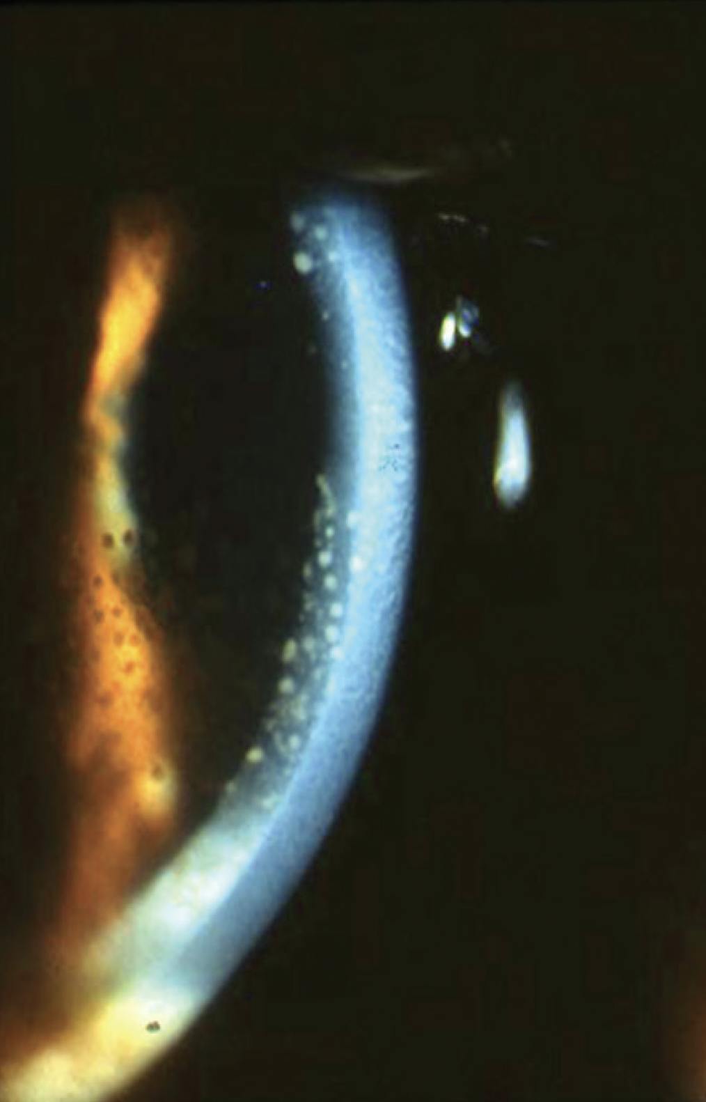 Zeroing in on Pediatric Uveitis - Modern Optometry