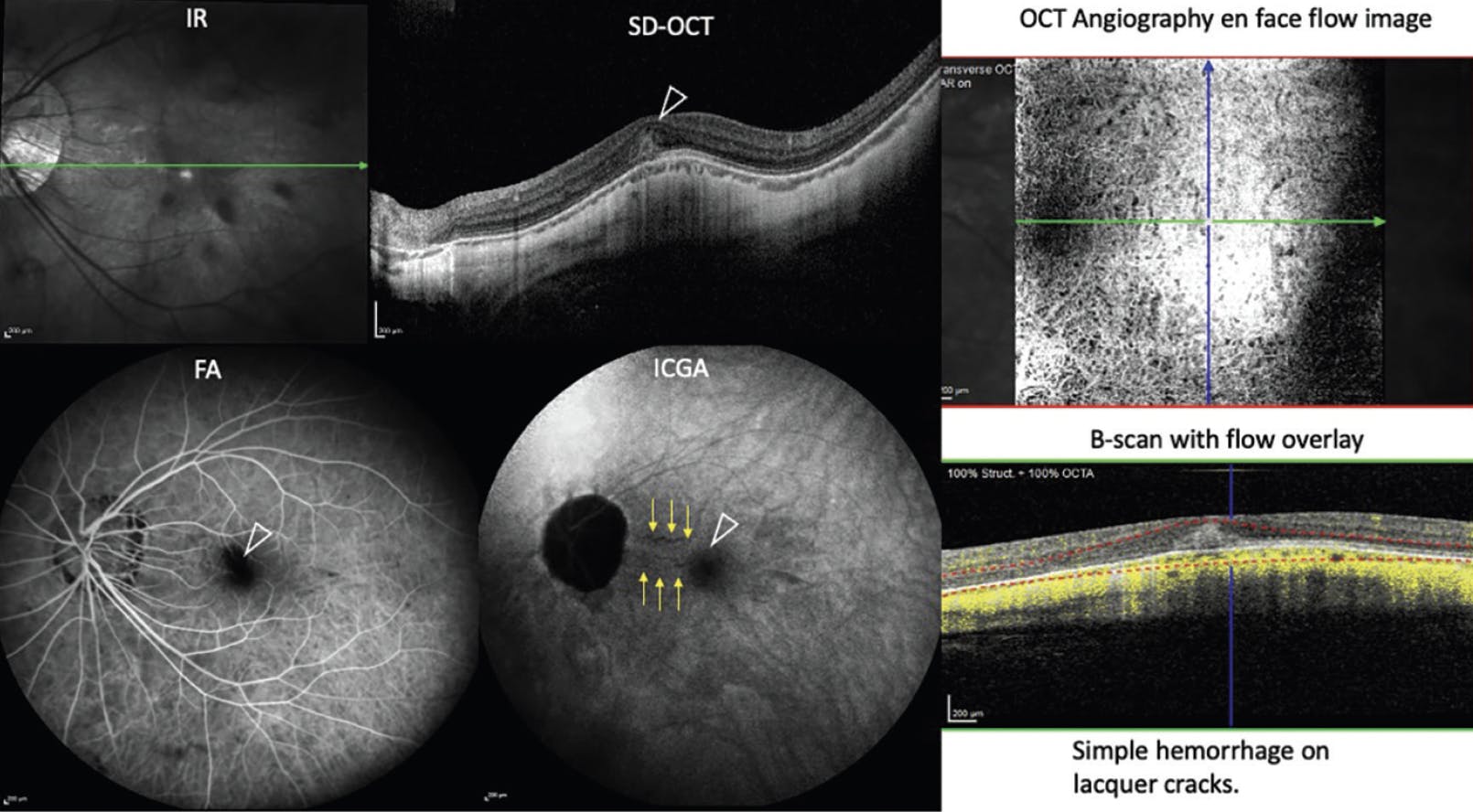語学+参考書 Electrodiagnosis of retinal di Imaging Considerations in Pathologic Myopia - Retina Today