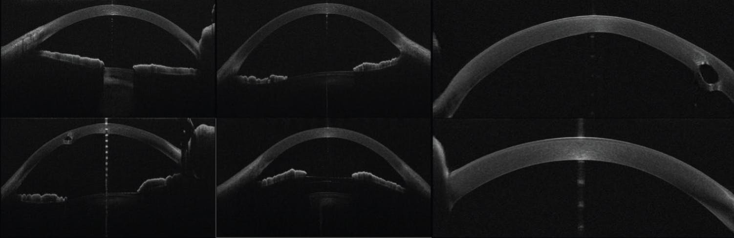 <p>Figure 1. Representative GAN-generated anterior segment OCT images illustrating the diversity captured in synthetic scans. These include variations in corneal surgeries (eg, an EVO ICL and ICRSs) and artifacts such as central flares and eyelid shadows to enhance training for diverse clinical scenarios.</p>