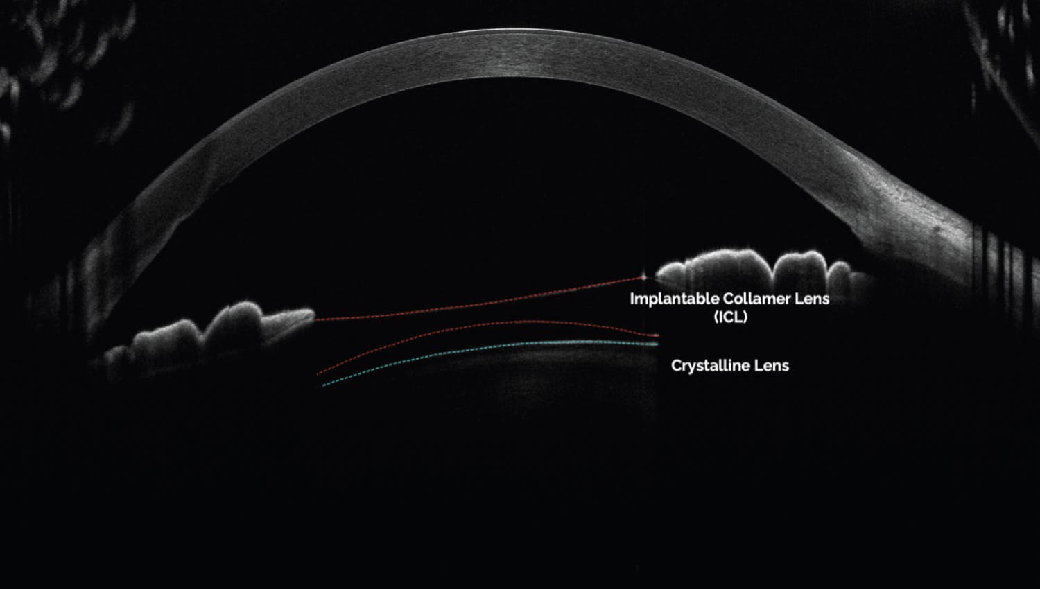 <p>Figure 2. An example of an OCT scan of a low-vault ICL used to train the authors’ deep learning model for vault measurement.</p>