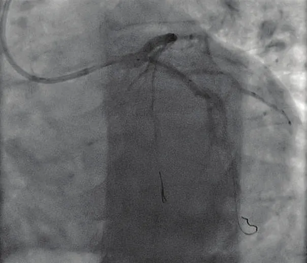 Figure 3. Post stenting of proximal Cx lesion.