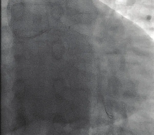 Figure 2. Accessing and thrombectomy of Cx artery.