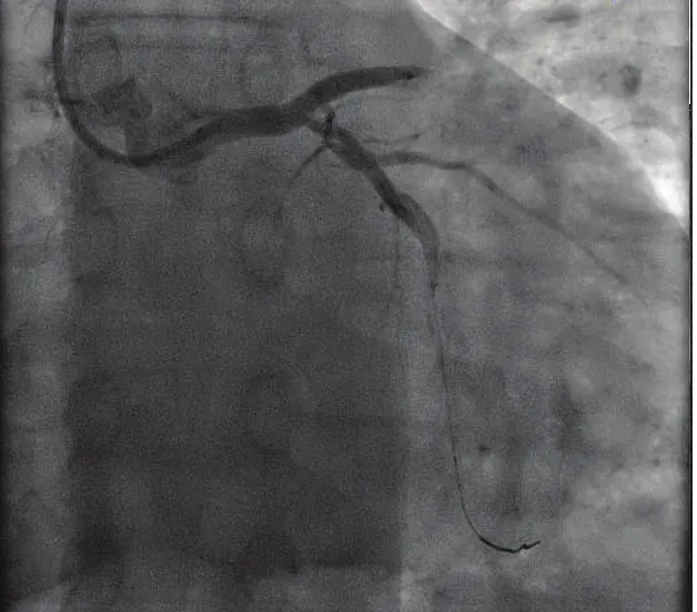 Figure 1. Procedural imaging of Cx and LAD.
