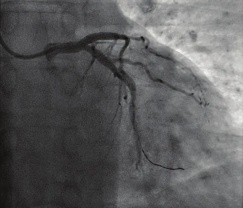 Figure 4. Post thrombectomy of Cx and LAD.