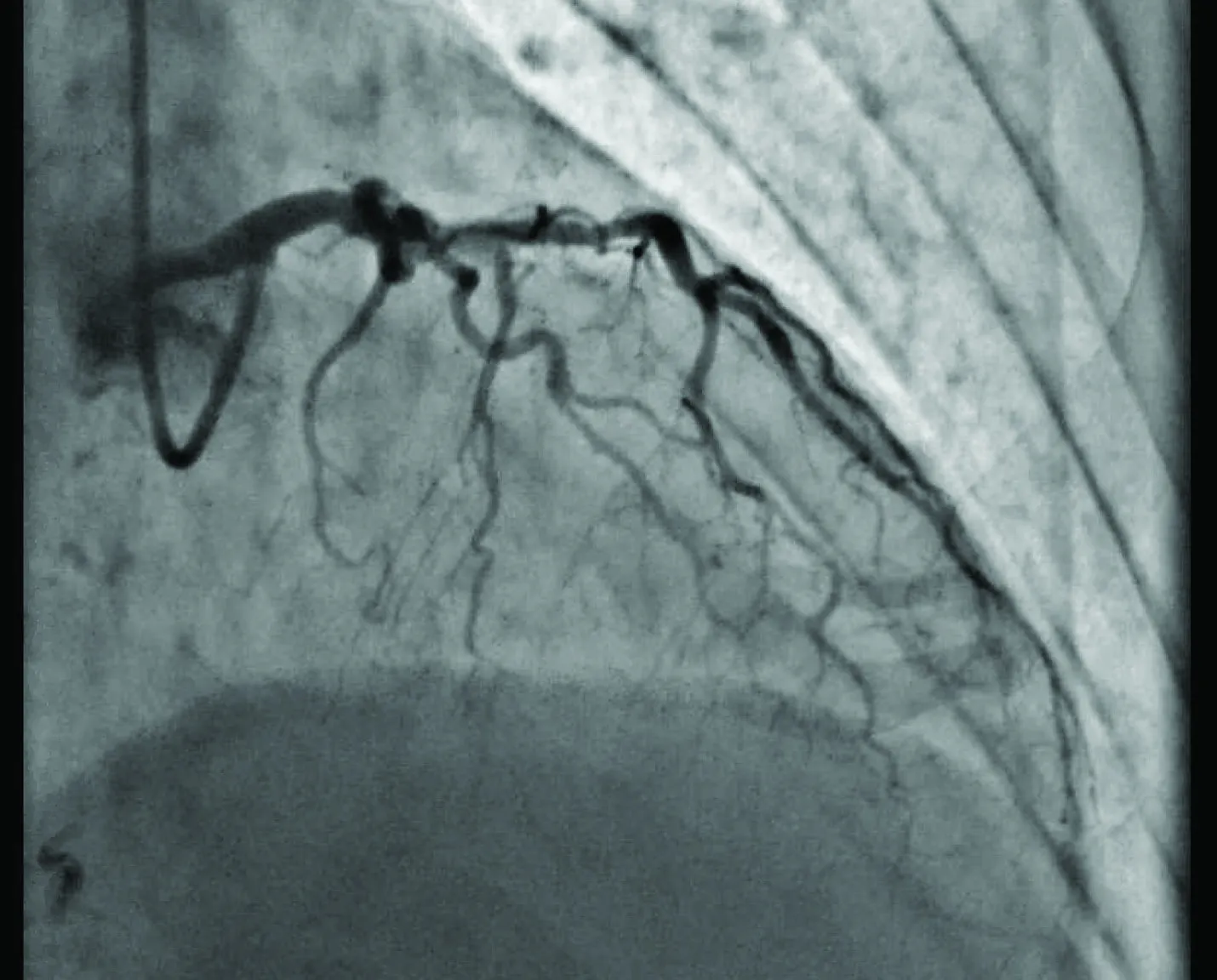 Figure 1. Left coronary artery diagnostic angiogram.