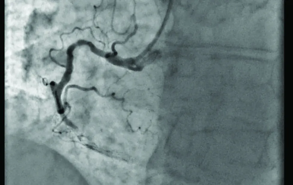 Figure 2. RCA diagnostic angiogram.