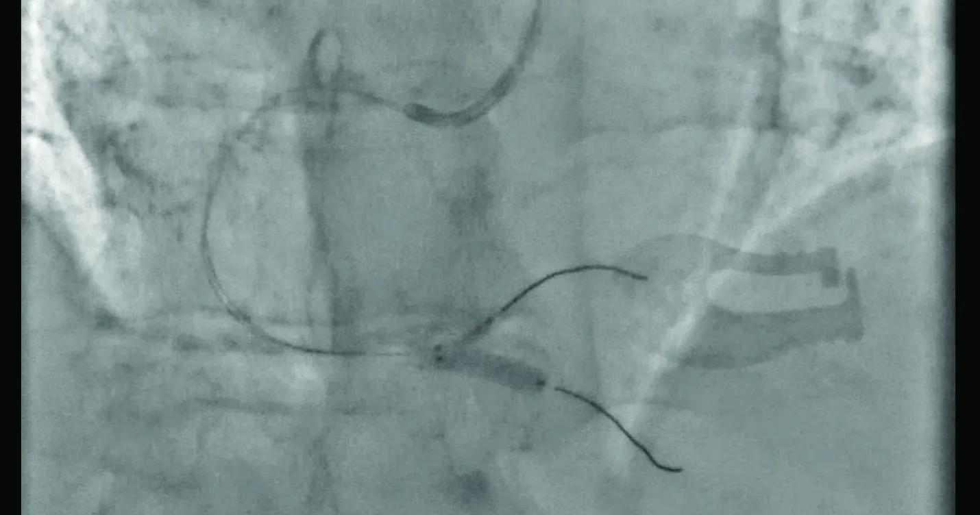 Figure 3. STEMI culprit RCA bifurcation PCI.