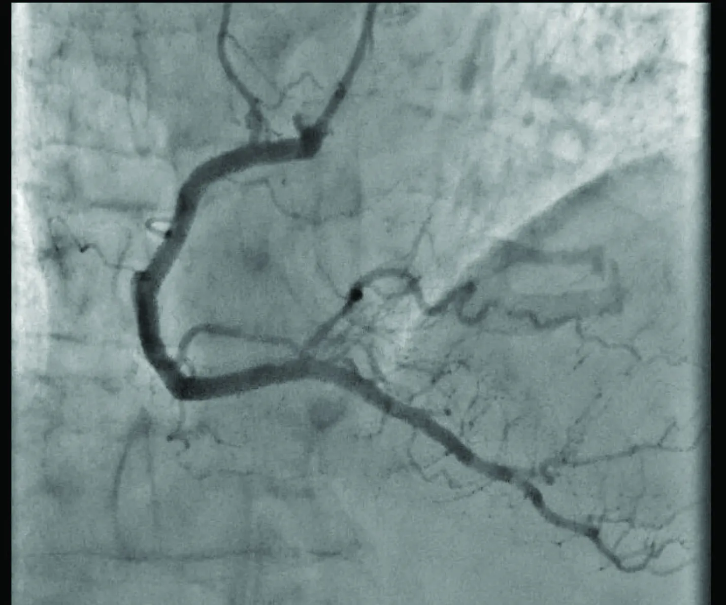Figure 4. Final post-PCI angiogram of RCA.