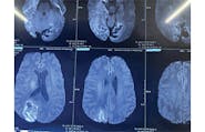 Disulfiram-Ethanol Reaction Causing Cortical Blindness image