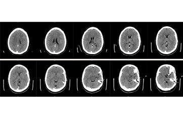 Management of Vein of Galen Thrombosis With Mechanical Thrombectomy ...