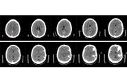 Management of Vein of Galen Thrombosis With Mechanical Thrombectomy image