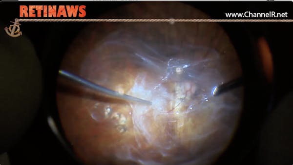 Maculoschisis thumbnail