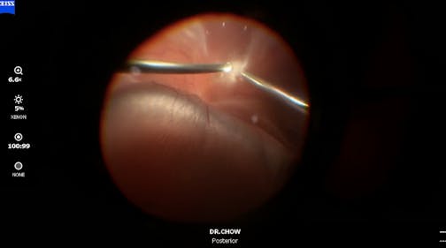 Pneumatic Retinopexy