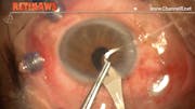 Dislocated Lens