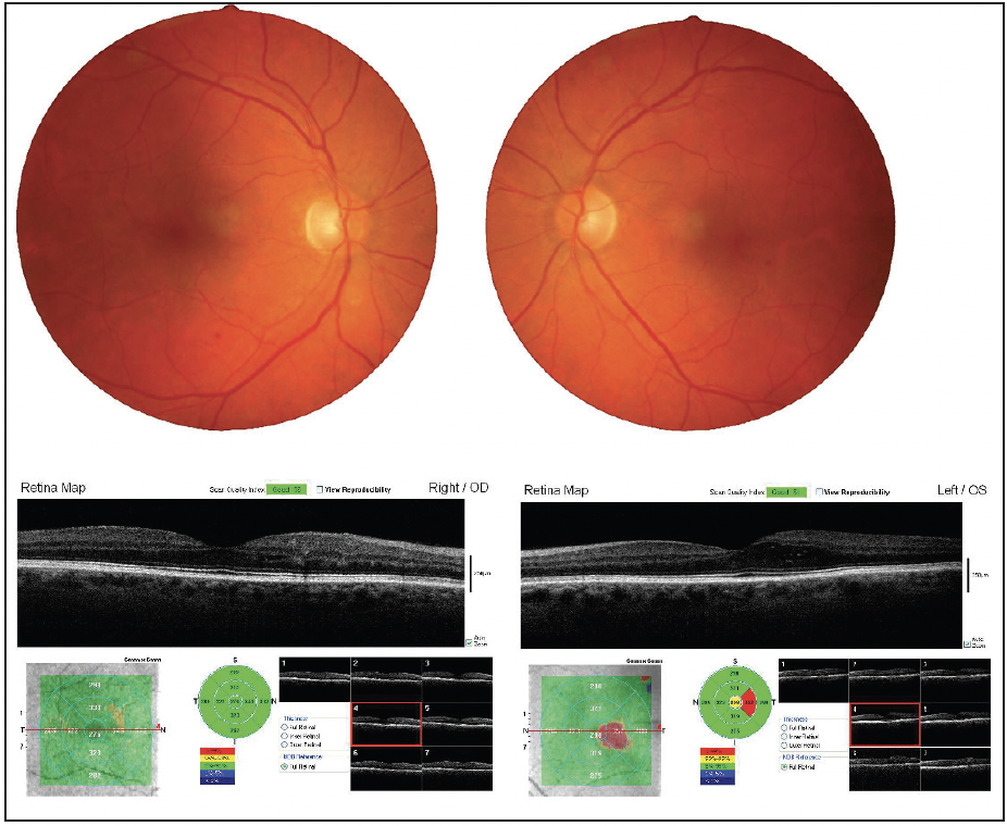 Macular Edema - Patients - The American Society of Retina Specialists