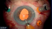 Silicone Oil Retention Sutures
