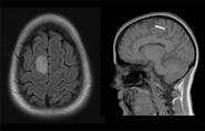 Supplementary Motor Area Glioma Presenting with Musicogenic Epilepsy: “Singing Seizures” image